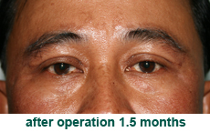 plastic-surgery-blepharoplasty